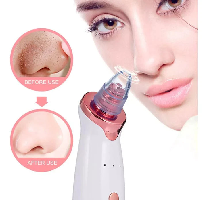 Máquina de Succión Facial — Elimina Puntos Negros